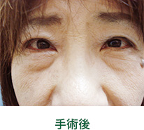 眼瞼下垂　例2　手術後　松山　眼科　たてまつ眼科　松山市　愛媛　愛媛県