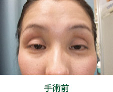 眼瞼下垂　例１　手術前　松山　眼科　たてまつ眼科　松山市　愛媛　愛媛県